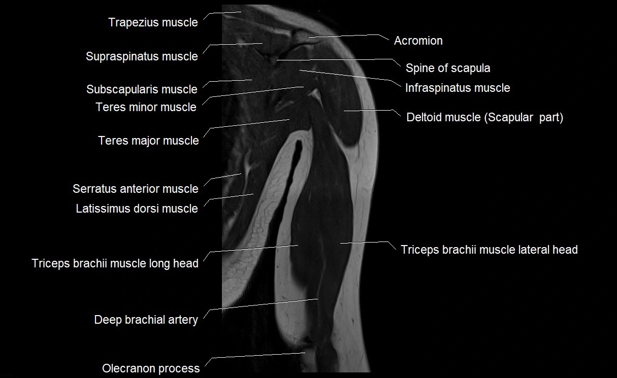 MRI upper arm (humerus ) coronal cross sectional anatomy image 22.webp
